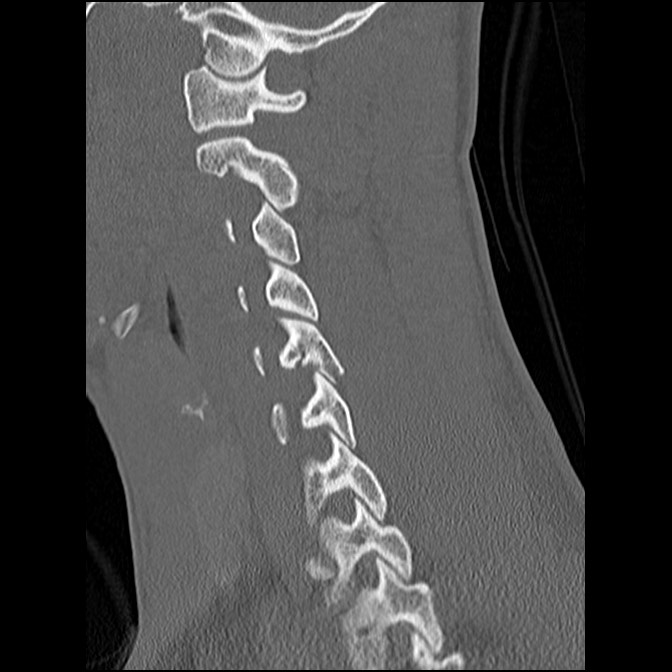 C5 facet fracture (Radiopaedia 58374-65499 Sagittal bone window 29).jpg