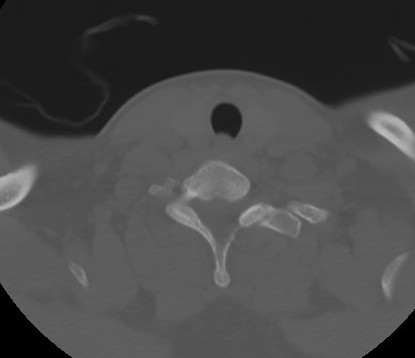 C7 laminar fracture and Klippel-Feil syndrome (Radiopaedia 86710-102850 Axial bone window 60).jpg