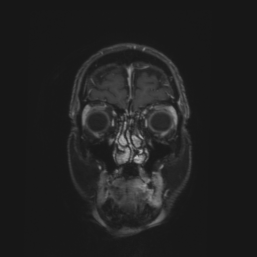 File:CNS lymphoma with steroid response (Radiopaedia 37980-39921 Coronal T1 C+ 1).png