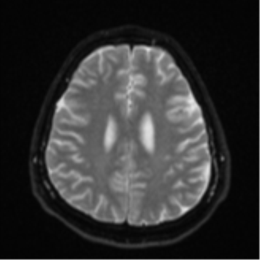 File:CNS vasculitis (Radiopaedia 55715-62263 Axial DWI 21).png