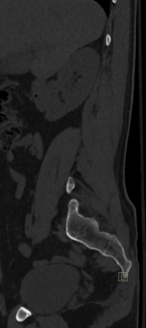 Calcaneal fractures with associated L2 burst fracture (Radiopaedia 71671-82493 Sagittal bone window 72).jpg