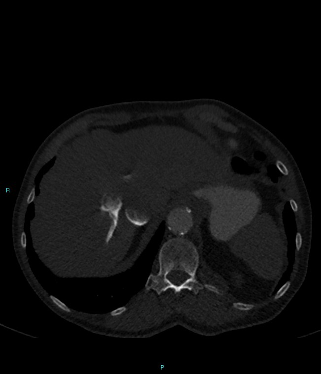 Calcified cerebral emboli from left ventricular thrombus (Radiopaedia 84420-99760 Axial bone window 76).jpg