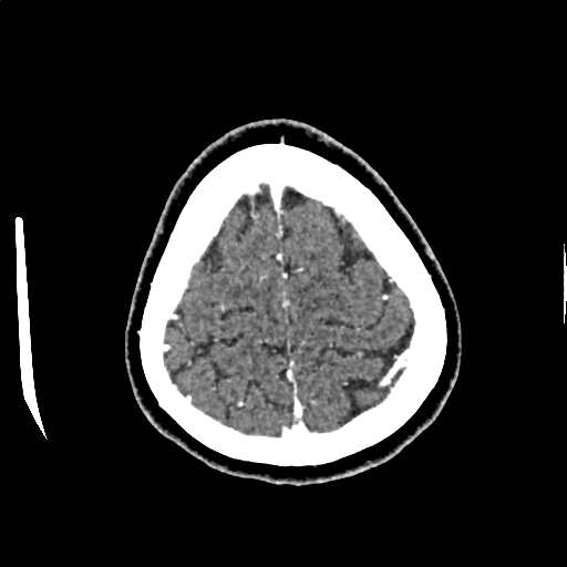 Calcified cerebral hydatid cyst (Radiopaedia 65603-74717 Axial with contrast 72).jpg