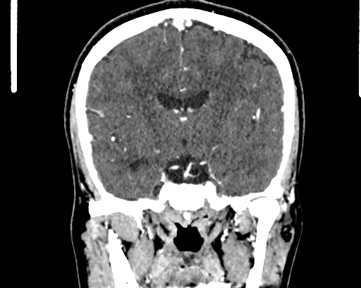 Calcified cerebral hydatid cyst (Radiopaedia 65603-74717 C 35).jpg