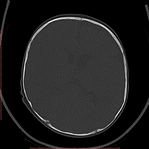 File:Calcified middle cerebral artery embolism (Radiopaedia 78949-91860 Axial bone window 37).jpg