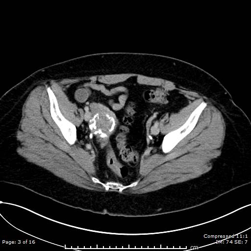 File:Calcified uterine fibroid (Radiopaedia 56077-62759 Axial 13).jpg