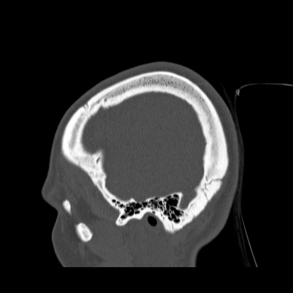 Calvarial osteoma (Radiopaedia 36520-38079 Sagittal bone window 93).jpg