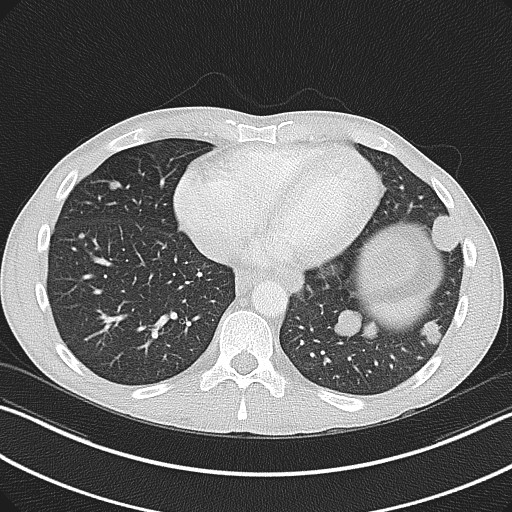 File:Cannonball metastases - testicular choriocarcinoma (Radiopaedia 84510-99891 Axial lung window 70).jpg