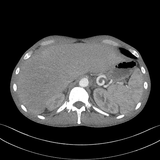 Cannonball metastases - testicular choriocarcinoma (Radiopaedia 84510-99891 B 102).jpg
