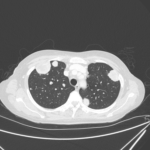 Canonball lung metastasis (Radiopaedia 77634-89837 Axial lung window 45).jpg