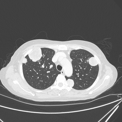 Canonball lung metastasis (Radiopaedia 77634-89837 Axial lung window 50).jpg