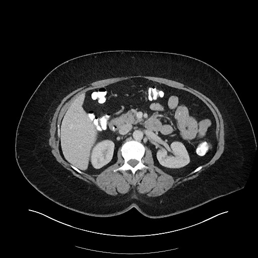 File:Carcinoid tumor - terminal ileum (Radiopaedia 60931-68739 Axial 37).jpg
