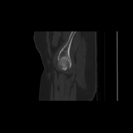 Carcinoma cervix- brachytherapy applicator (Radiopaedia 33135-34173 Sagittal bone window 3).jpg