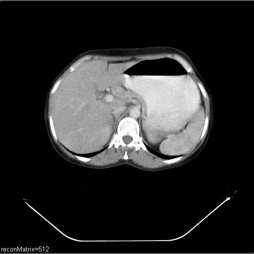 File:Carcinoma of esophagus (Radiopaedia 27356-27550 A 2).jpg