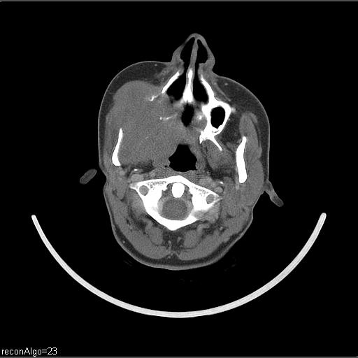 Carcinoma of the maxillary antrum (Radiopaedia 53805-59888 Axial C+ delayed 48).jpg