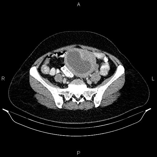 File:Carcinoma of uterine cervix (Radiopaedia 85861-101700 A 62).jpg