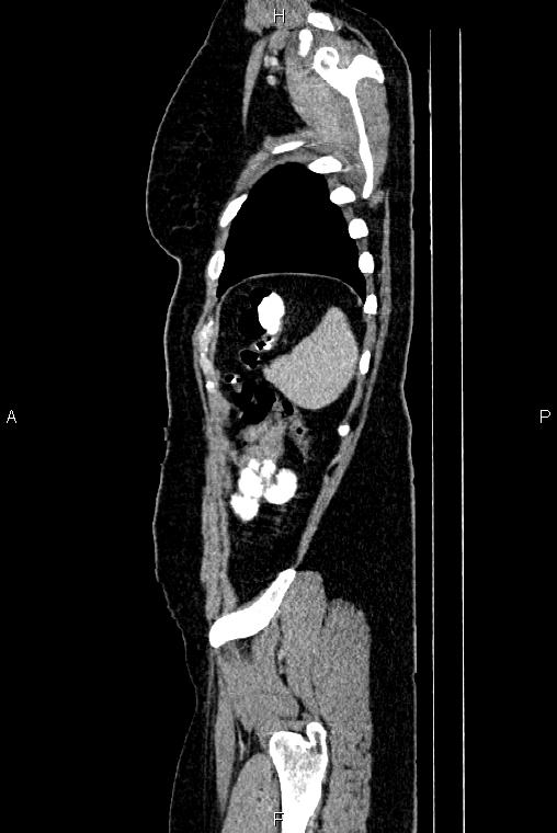 Carcinoma of uterine cervix (Radiopaedia 85861-101700 D 79).jpg