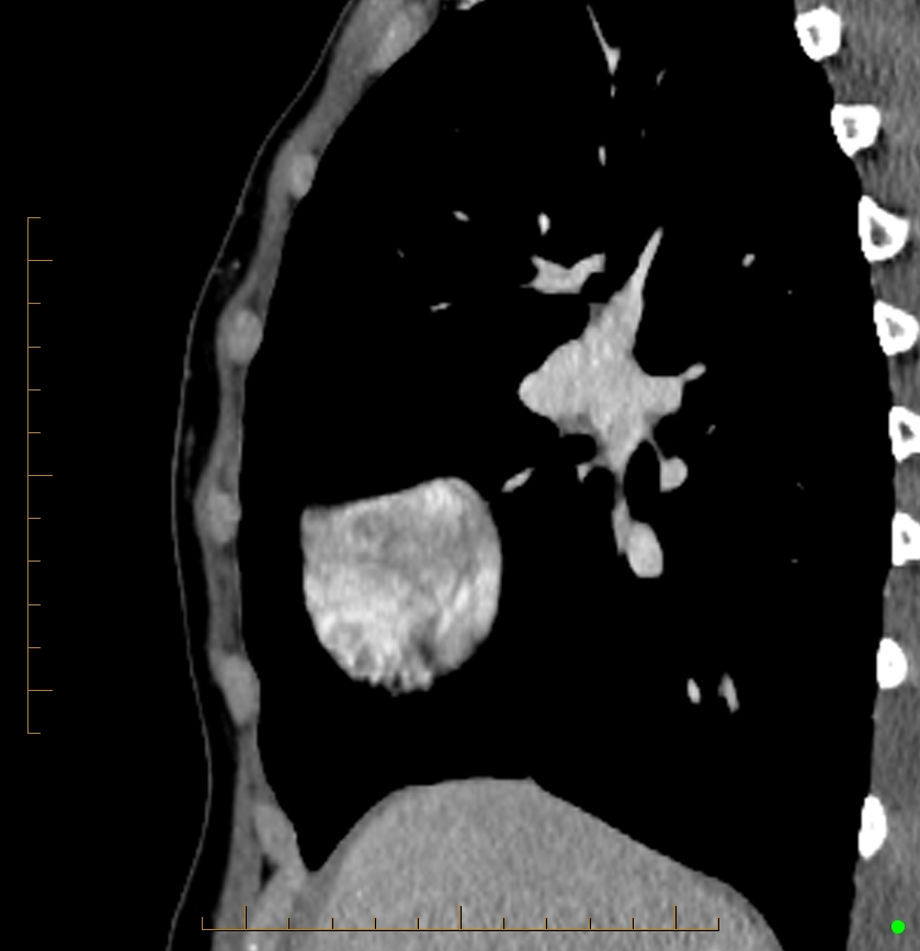 Cardiac paraganglioma (Radiopaedia 76345-88005 C 91).jpg