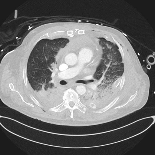 Cardiac trauma (Radiopaedia 32874-33858 Axial lung window 25).jpg