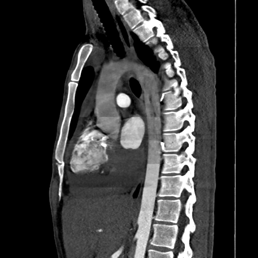 Cardiac tumor - undifferentiated pleomorphic sarcoma (Radiopaedia 45844-50134 B 37).png