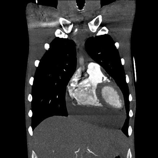 Cardiac tumor - undifferentiated pleomorphic sarcoma (Radiopaedia 45844-50134 Coronal non-contrast 17).png