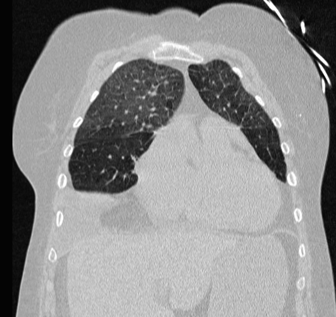 Cardiogenic pulmonary edema (Radiopaedia 29213-29609 Coronal lung window 18).jpg