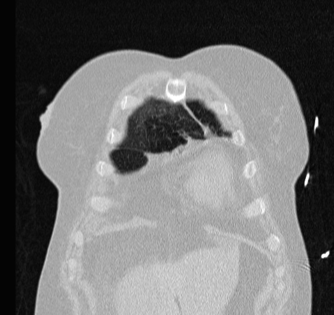 Cardiogenic pulmonary edema (Radiopaedia 29213-29609 Coronal lung window 7).jpg