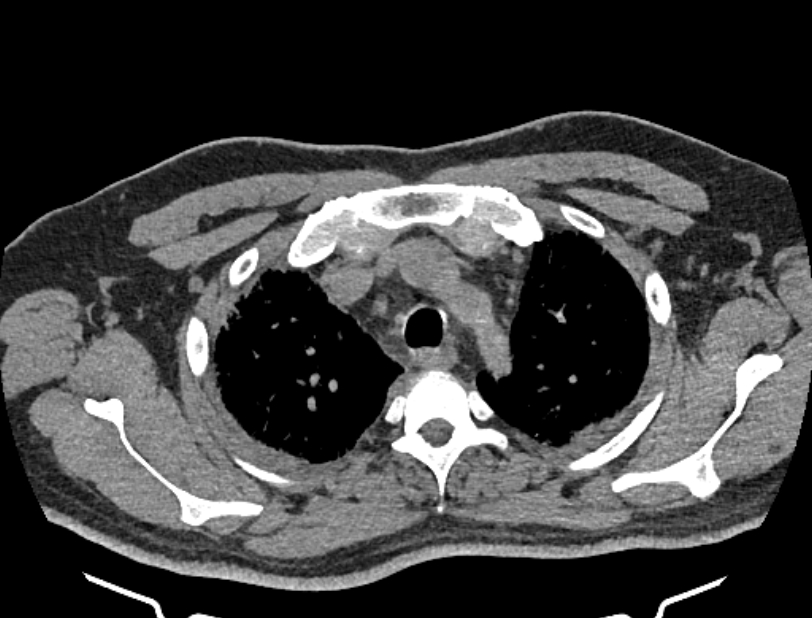 Cardiogenic pulmonary edema (Radiopaedia 68180-77678 Axial non-contrast 8).jpg