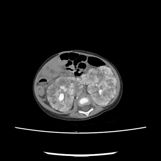 Caroli disease with autosomal recessive polycystic kidney disease (ARPKD) (Radiopaedia 89651-106703 E 141).jpg