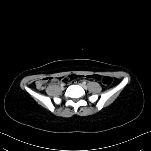 Caroli disease with medullary sponge kidney (Radiopaedia 82622-96804 C 52).jpg