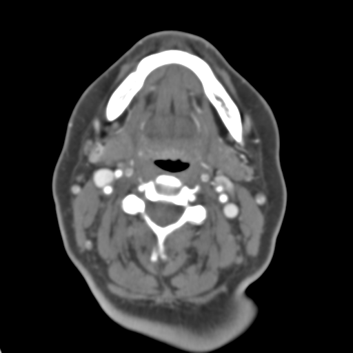 Carotico ophthalmic aneurysm (Radiopaedia 42916-46148 A 65).png