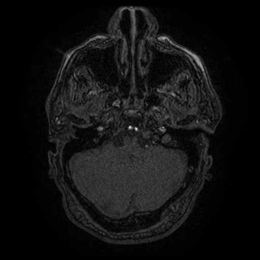 Carotid arterial dissection with acute cerebral infarction (Radiopaedia 26636-26784 MRA 142).jpg