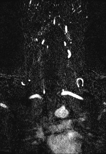 Carotid artery dissection (Radiopaedia 28441-28689 Coronal MRA 52).jpg