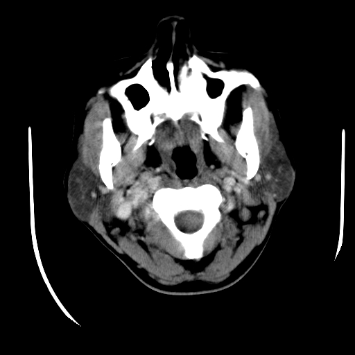 File:Carotid body tumor (Radiopaedia 27890-28124 A 8).jpg