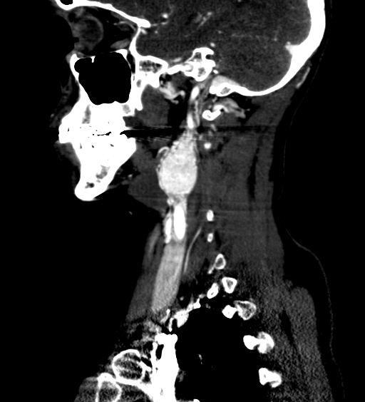 File:Carotid body tumor (Radiopaedia 39845-42300 D 36).jpg