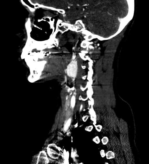 Carotid body tumor (Radiopaedia 39845-42300 D 49).jpg