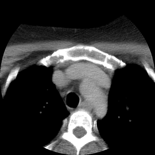 Carotid body tumor (paraganglioma) (Radiopaedia 38586-40729 A 70).jpg