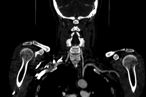File:Carotid bulb pseudoaneurysm (Radiopaedia 57670-64616 D 62).jpg