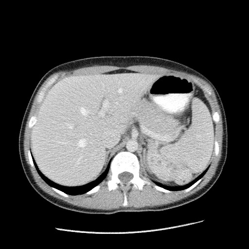 Castleman disease with fibrous pseudotumor in the abdomen (Radiopaedia 77296-89373 A 29).jpg