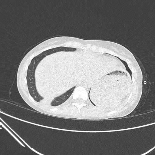 Catamenial pneumothorax (Radiopaedia 27946-28197 lung window 135).jpg