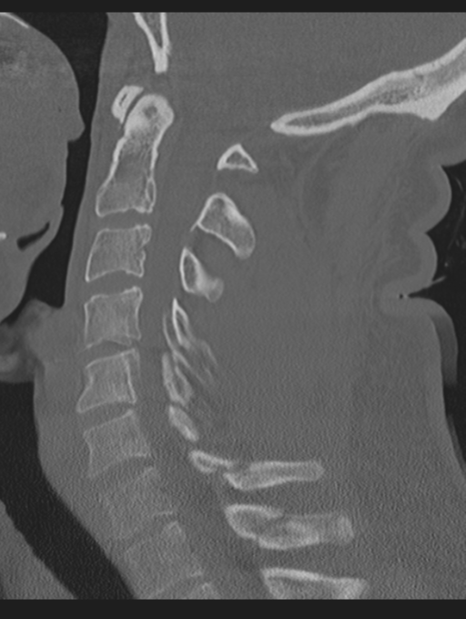 Cavernoma of cervical cord (Radiopaedia 50838-56346 Sagittal bone window 41).png