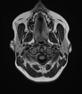 File:Cavernoma with bleed - midbrain (Radiopaedia 54546-60774 Axial FLAIR 1).png