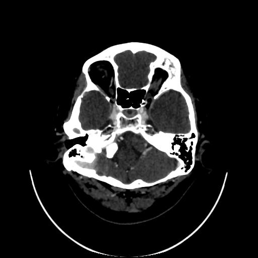File:Cavernoma with developmental venous anomaly (Radiopaedia 22470-22506 C 21).jpg