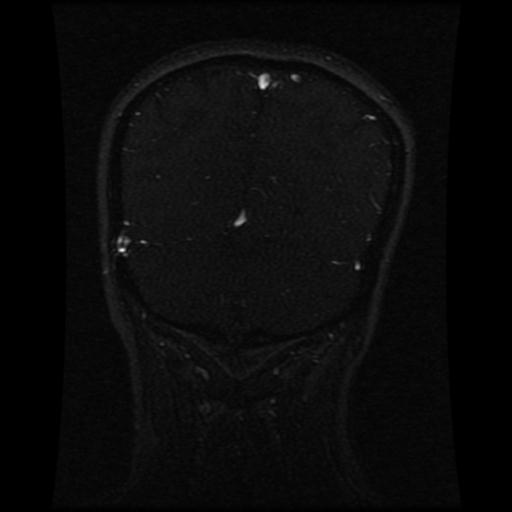 Cavernoma with developmental venous anomaly (Radiopaedia 22470-22507 MRV 43).jpg