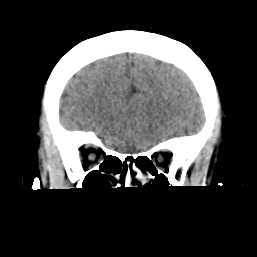 Cavernoma with hemorrhage (Radiopaedia 70755-80931 Coronal non-contrast 17).png