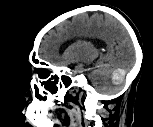 Cavernous hemangioma of the cerebellar falx (Radiopaedia 73025-83723 B 200).jpg
