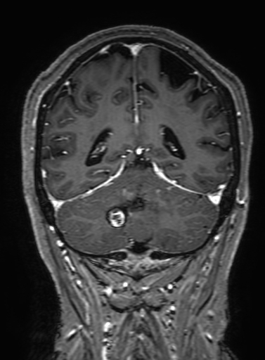 Cavernous hemangioma of the cerebellar falx (Radiopaedia 73025-83724 Coronal T1 C+ 274).jpg