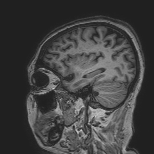 File:Cavernous hemangioma of the cerebellar falx (Radiopaedia 73025-83724 Sagittal T1 58).jpg