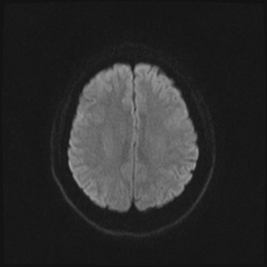 Cavernous sinus meningioma (Radiopaedia 63682-72367 DWI 56).jpg