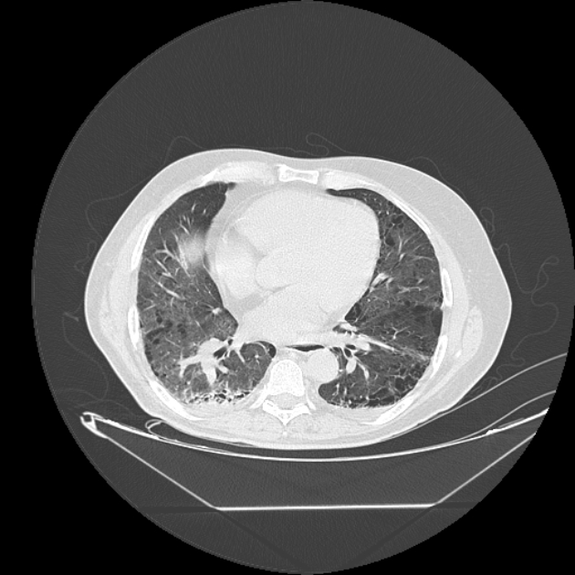 Cavitating bronchogenic carcinoma (Radiopaedia 44489-48162 Axial lung window 53).jpg